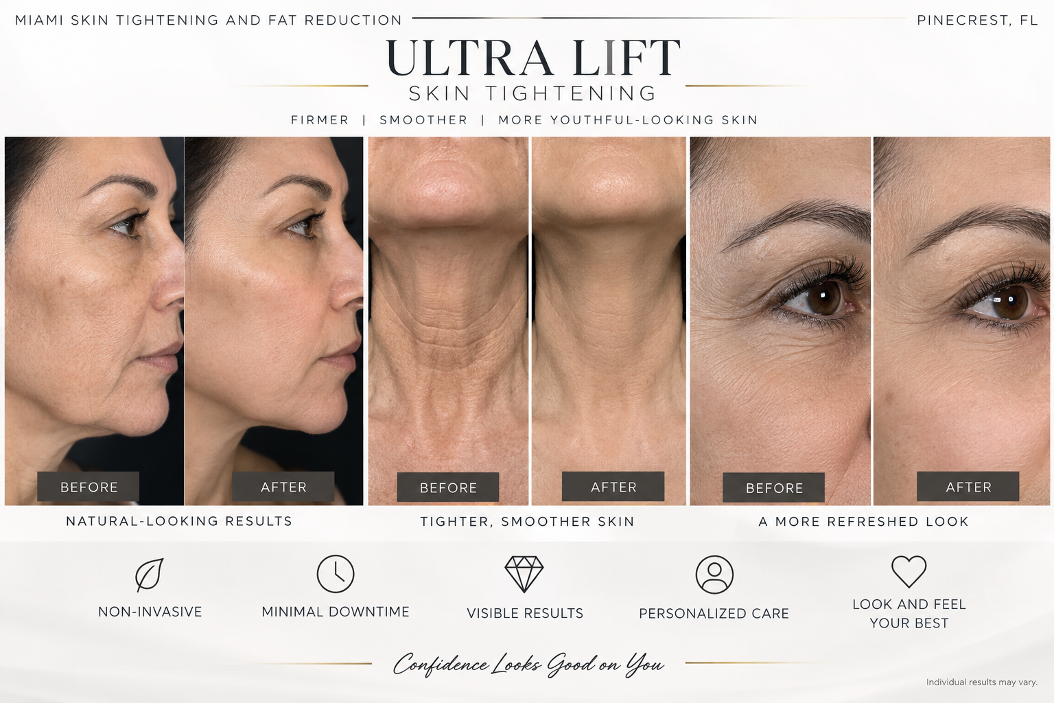 Ultra Lift skin tightening promotional poster with face, neck and eye-area before-and-after comparisons